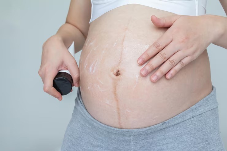 stretch marks saat hamil, cara menghilangkan stretch marks, stretch marks trimester ketiga, krim stretch mark aman untuk ibu hamil, perawatan kulit ibu hamil, tips mencegah stretch marks alami